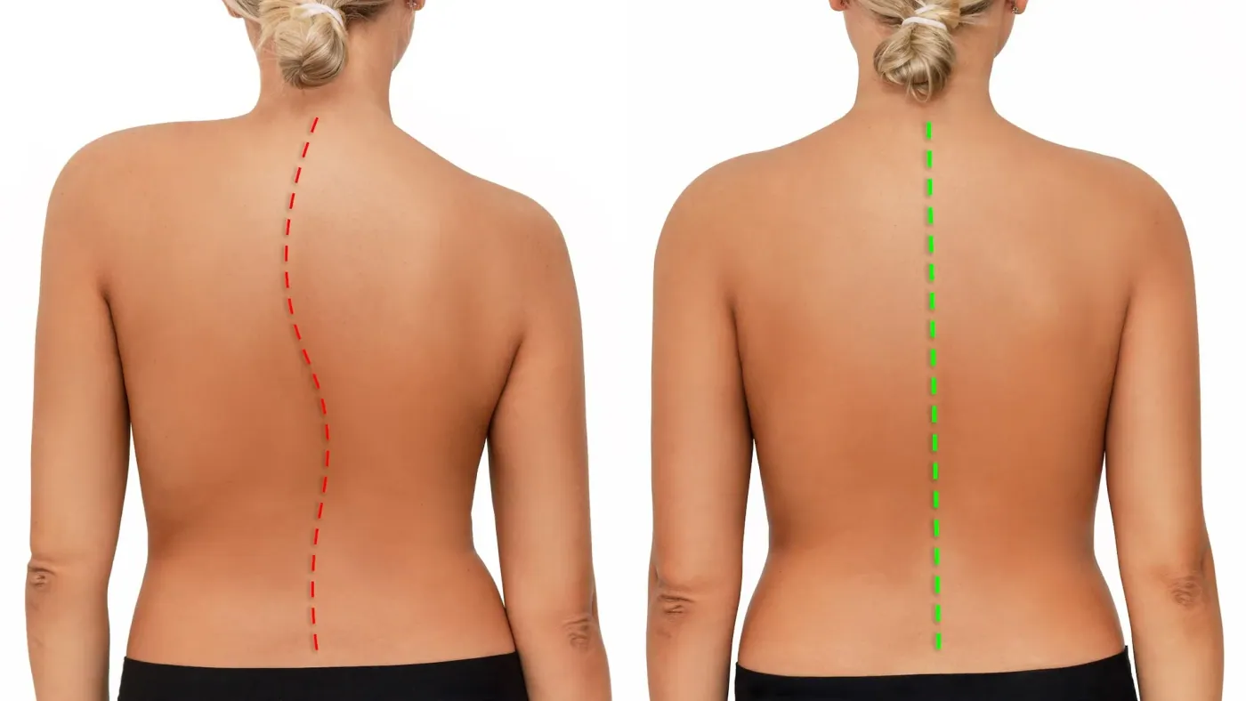 Scoliosis and Posture: Tips for Maintaining a Healthy Spine