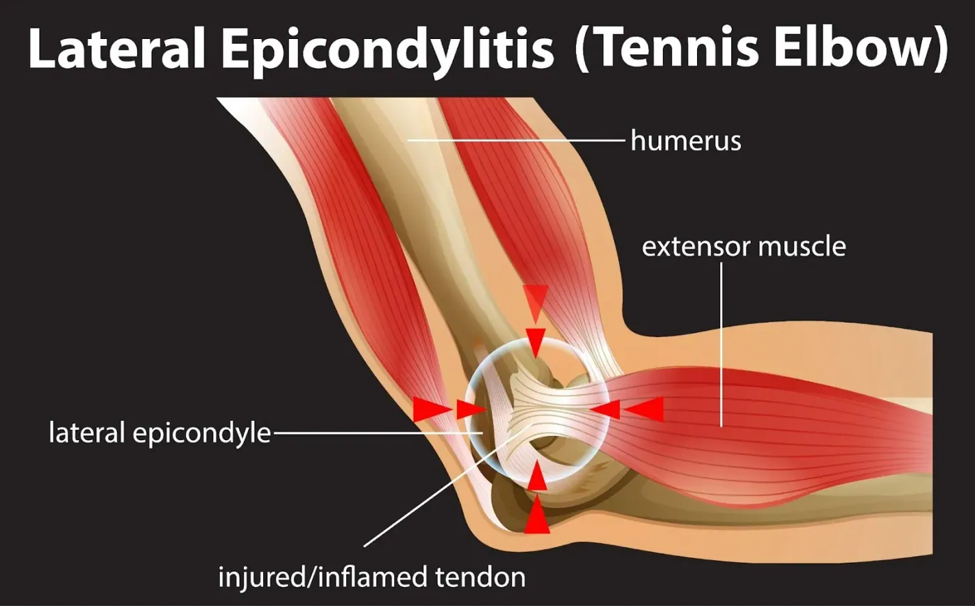 Tennis elbow what is it and how chiropractic care can help